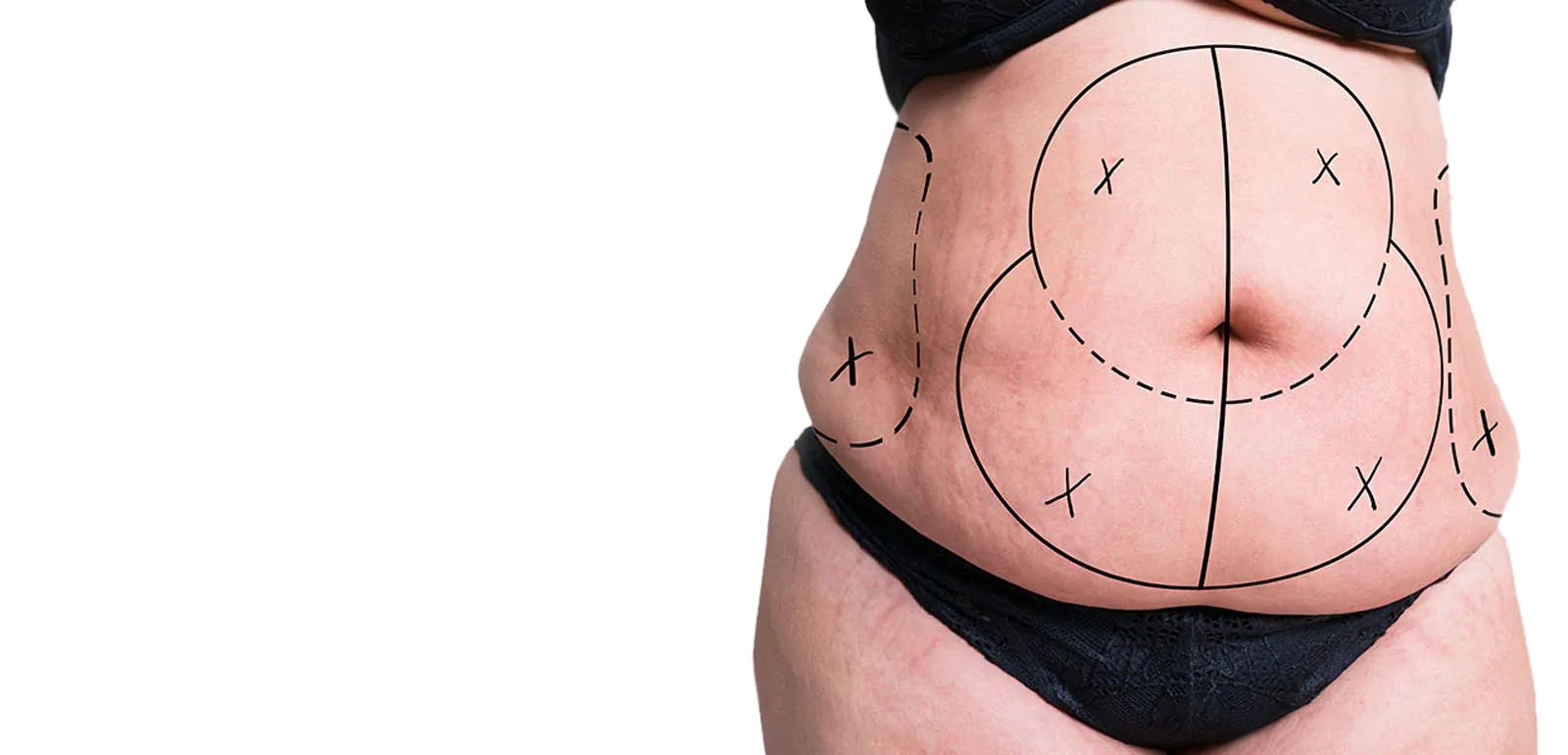 Tummy Tuck surgery - Aesthetic Art Plastic Surgeon Mumbai