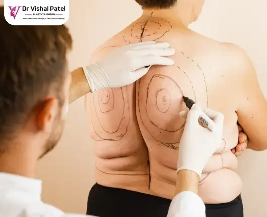 Vaser Liposuction in Mumbai