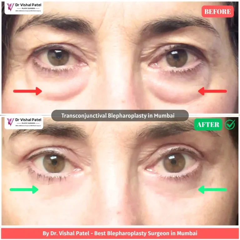 Eyelid Photos of women before and after transconjunctival blepharoplasty in Mumbai.