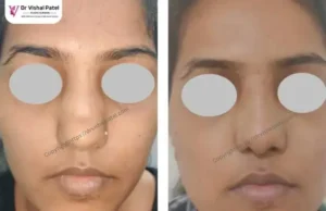Dorsal Hump fixed - Before After Photo - Front Angle view - A Female in Mumbai