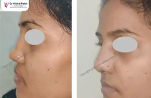 Dorsal Hump fixed - Before After Photo - Left Side view - A Female in Mumbai