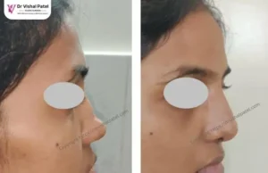 A lady in Mumbai with dorsal hump. See how the nose shape is fixed by Dr. Vishal Patel in Mumbai.