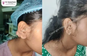 Ear Keloid Removal Treatment in Mumbai - Before After Photo of patient - Side View