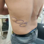 A Person with Multiple Lipoma on Back Side - Treated by Dr. Vishal Patel