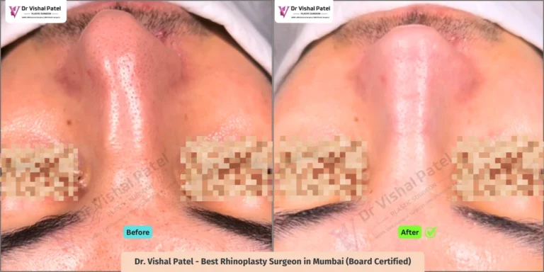 Crooked Nose - Revision Rhinoplasty done by Indian Male - Before After Result - Top Invert View