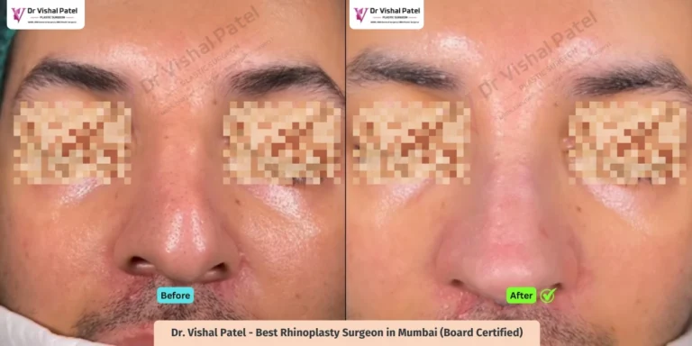 Crooked Nose - Revision Rhinoplasty done by Indian Male - Before After Result - Top View
