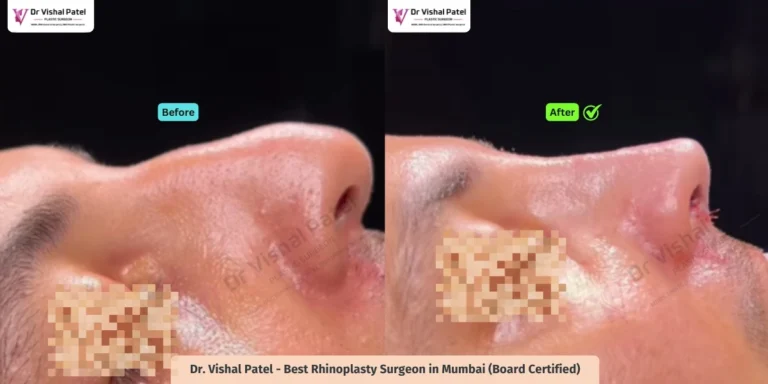 Crooked Nose - Revision Rhinoplasty in Mumbai - Indian Male - Before After Result - Side View
