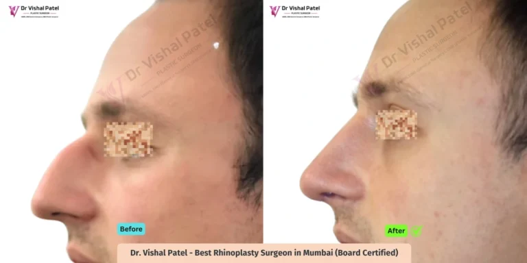 Dorsal Hump Nose Rhinoplasty in Mumbai - Before and After - Dr Vishal Patel - Side View