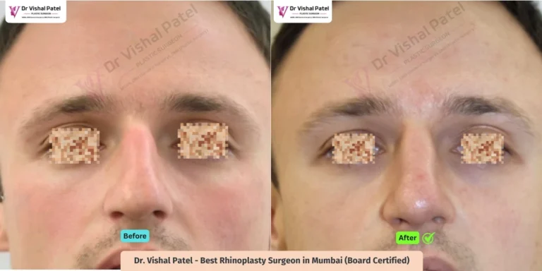 Dorsal Hump Rhinoplasty - Before and After - Dr Vishal Patel in Mumbai