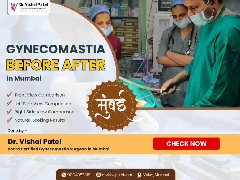 Gynecomastia Before After Photos in Mumbai India by Dr. Vishal Patel
