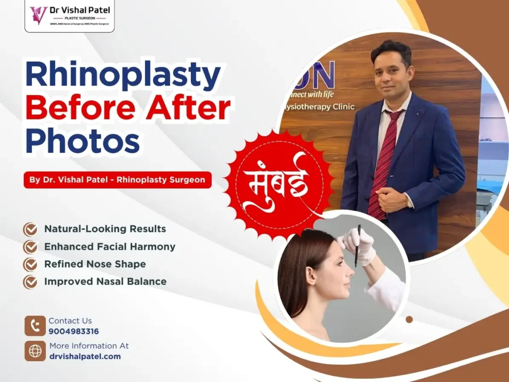 Rhinoplasty Before After Photos in Mumbai India by Dr. Vishal Patel