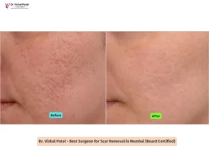 Acne Scars on Face - Scar Removal Surgery by Dr. Vishal Patel - Before After Photo
