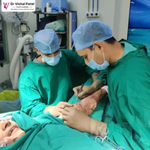 Best Plastic Surgeon for Skin Grafting for Burn Scar Treatment in Mumbai - Dr Vishal Patel