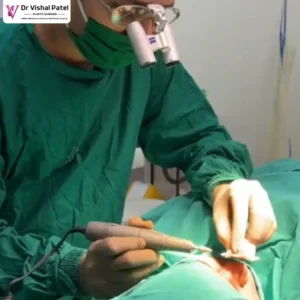 Best Plastic Surgeon in Mumbai for Dermabrasion Treatment - Dr Vishal Patel