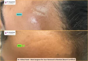 Scar Revision on Face - Before After Photo - Mumbai Male - Dr. Vishal Patel