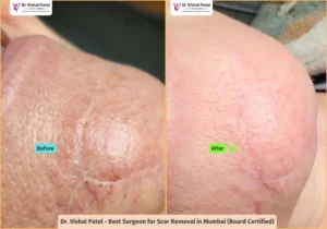 Scar revision in Mumbai for chin scar removal