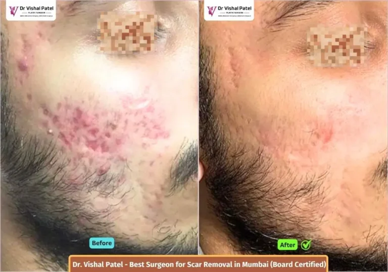 Acne Scar on Face - Before and After - Scar Treatment by Dr Vishal Patel