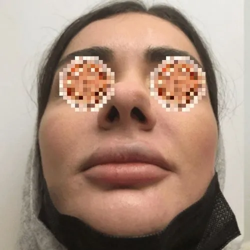 An Indian Female with Wide nose. Candidate for Wide nose rhinoplasty in India.