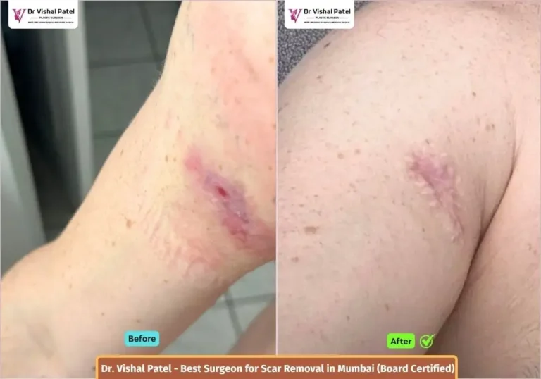 Scars on hand - Before and After - Dr. Vishal Patel