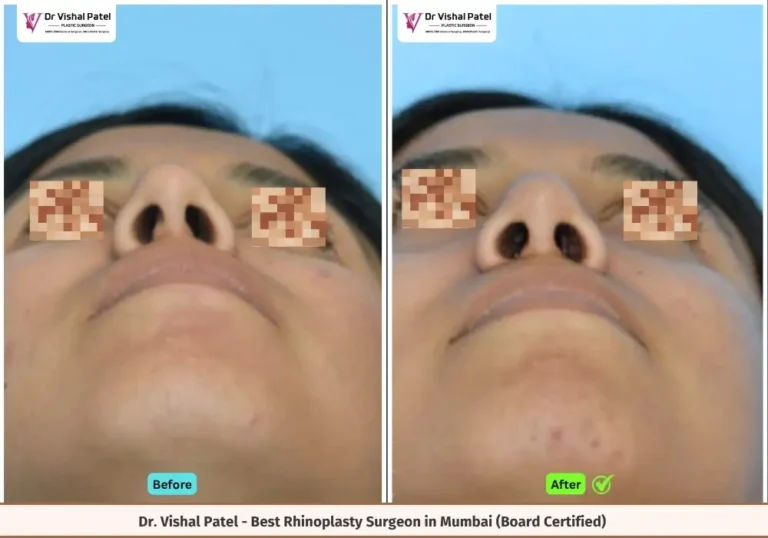 Before and After Crooked Nose Correction of Indian Female - Surgery by Dr. Vishal Patel Mumbai