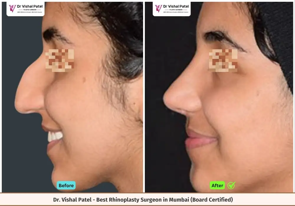 Before and After Dorsal Hump Correction & Full Rhinoplasty of Indian Female - Rhinoplasty Before After Photos by Dr. Vishal Patel