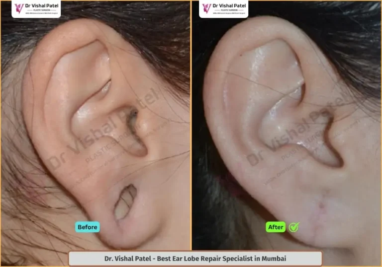 Ear Lobe Reconstruction Treatment in Mumbai by Dr. Vishal Patel - Indian Female