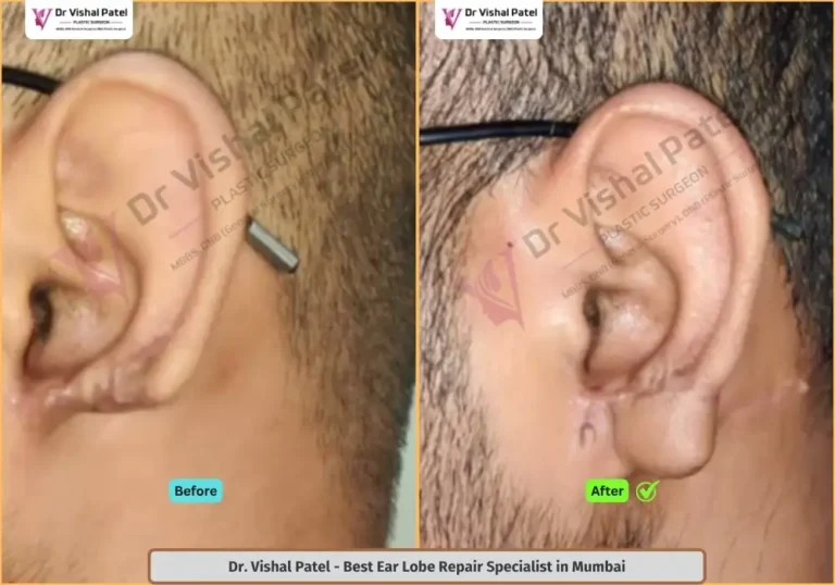Ear Lobe Reconstruction in Mumbai by Dr Vishal Patel in Malad - Indian Male