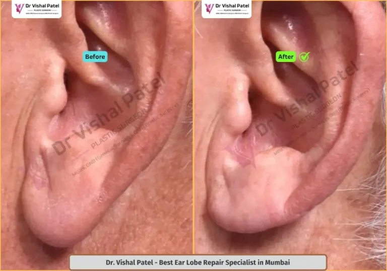 Ear Lobe Reduction in Mumbai by Dr. Vishal Patel - Indian Male