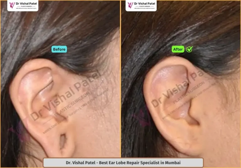 Ear lobe hole repair in Mumbai by Dr. Vishal Patel - Mumbai Female