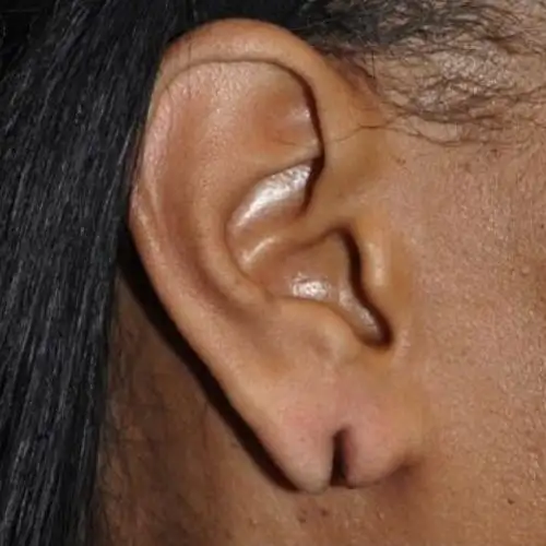 Ear lobe repair cost in Mumbai - Explained by Dr. Vishal Patel