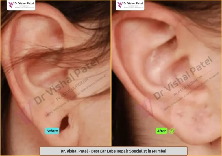 Earlobe Reconstruction Surgery in Mumbai by Dr. Vishal Patel - Female in Mumbai India