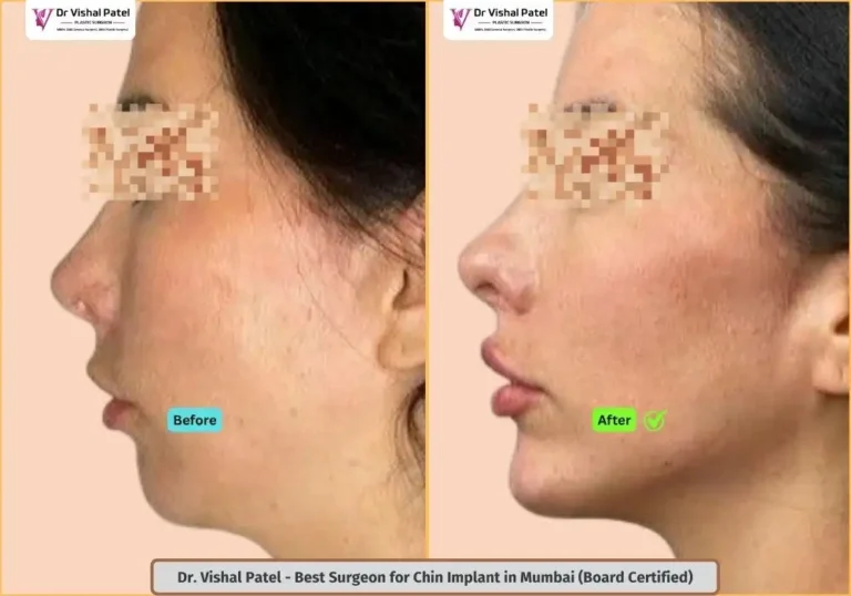 Female Chin Augmentation in Mumbai India - Before After Photo Indian Female