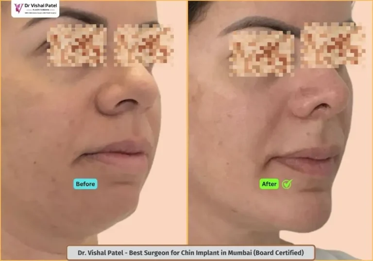 Female Chin implant in Mumbai India - Before After Photo