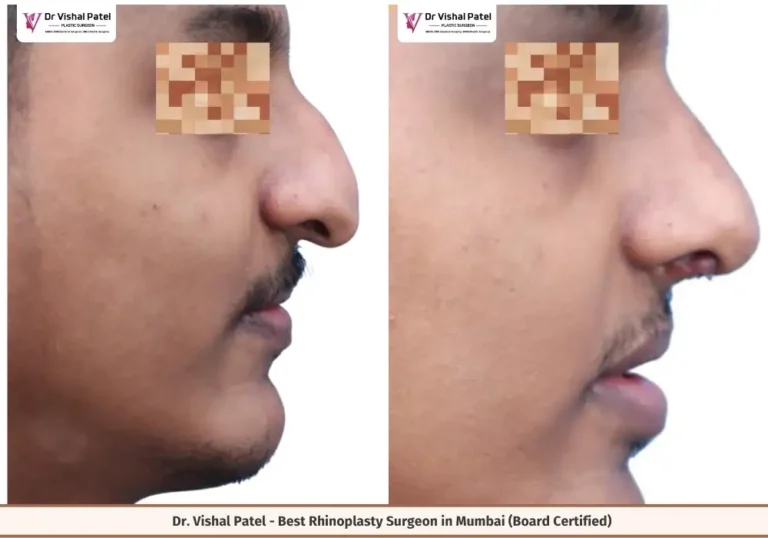Full Rhinoplasty with Tip Correction - Indian Male - Surgery by Dr. Vishal Patel