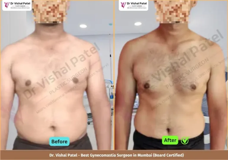 Grade 1 Gynecomastia Surgery in Mumbai - Before & After Photos of Indian Male from Kandivali Mumbai - Front View