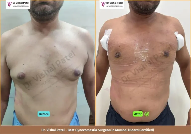 Grade 2 Gynecomastia Surgery in Mumbai - Before & After Photos of Indian Male from Andheri West - Front