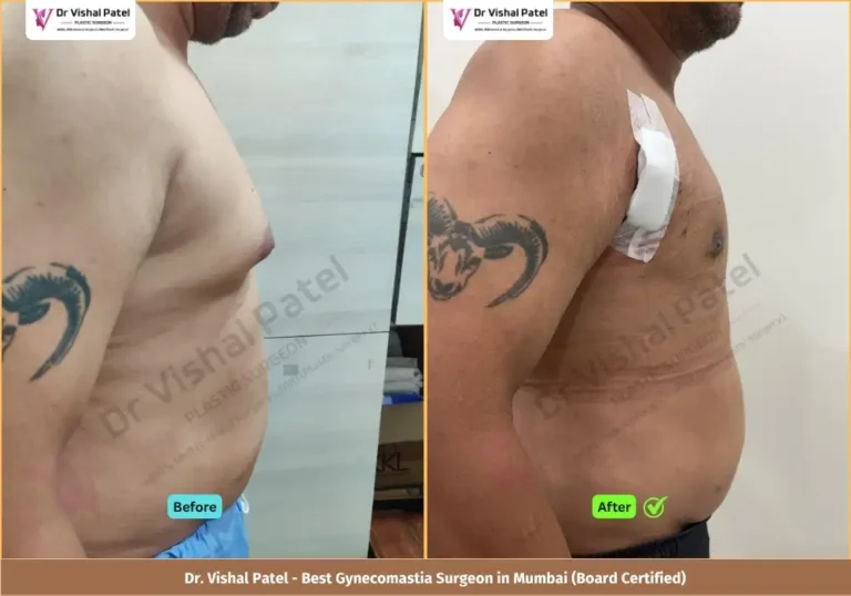 Grade 2 Gynecomastia Surgery in Mumbai - Before & After Photos of Indian Male from Andheri West - Side