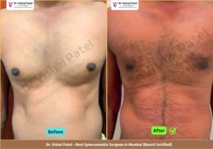 Grade 2 Gynecomastia Surgery in Mumbai - Before & After Photos of Indian Male from Borivali Mumbai - Front View