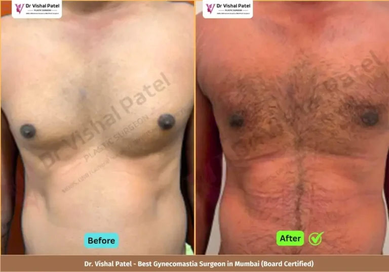 Grade 2 Gynecomastia Surgery in Mumbai - Before & After Photos of Indian Male from Borivali Mumbai - Front View