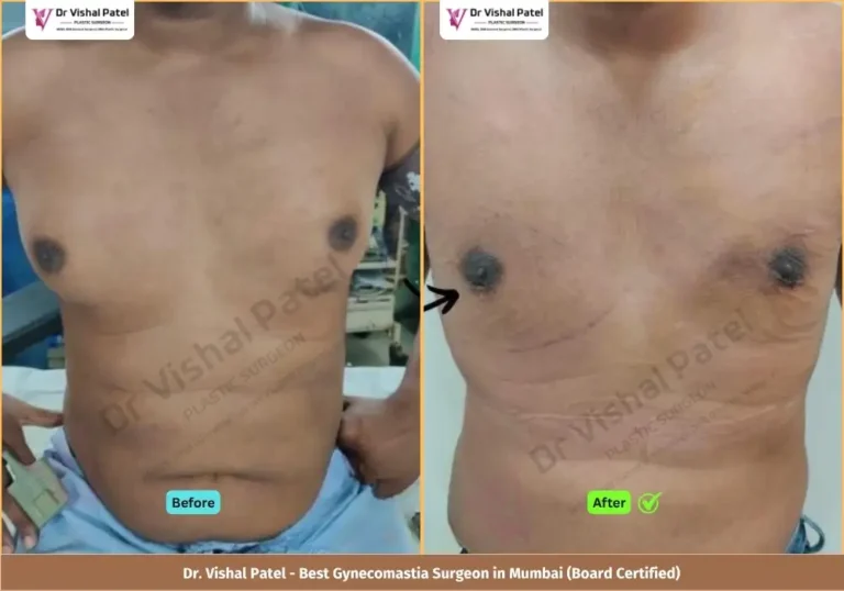 Grade 2 Gynecomastia Surgery in Mumbai - Before & After Photos of Indian Male from Malad West - Front