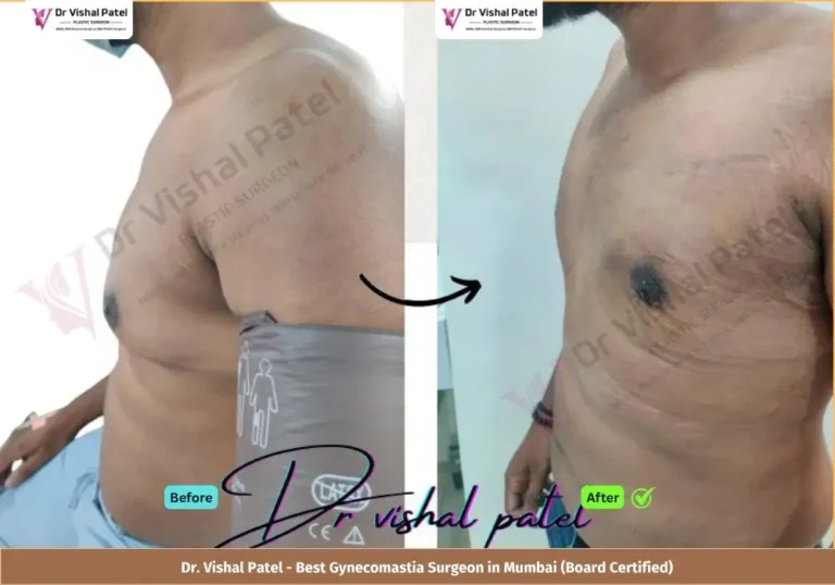Grade 2 Gynecomastia Surgery in Mumbai - Before & After Photos of Indian Male from Malad West - Left Side