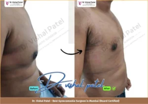 Grade 2 Gynecomastia Surgery in Mumbai - Before & After Photos of Indian Male from Malad West - Side