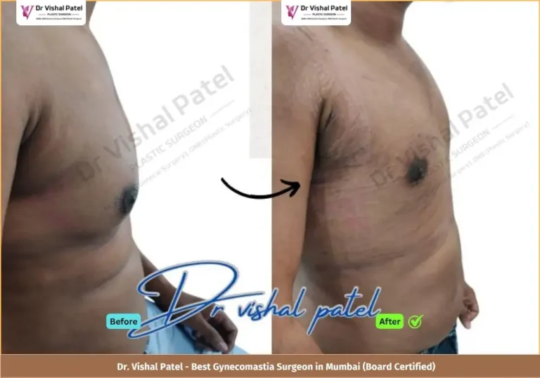 Grade 2 Gynecomastia Surgery in Mumbai - Before & After Photos of Indian Male from Malad West - Side