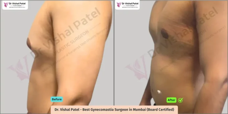 Grade 3 Gynecomastia - Before After Photo Indian Male - Surgery by Dr Vishal Patel - Side view