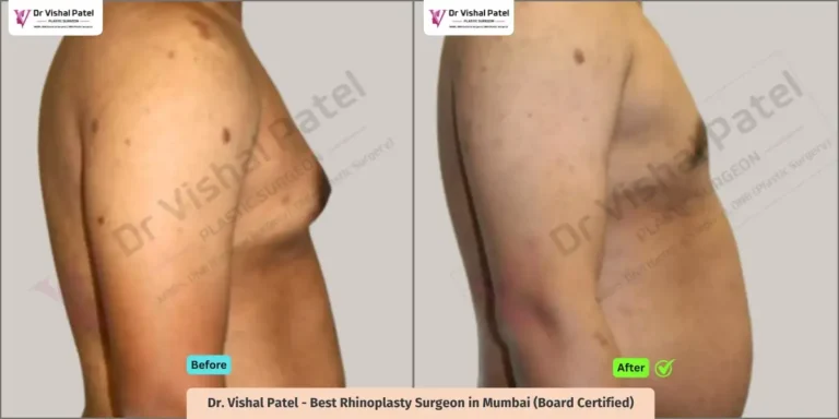 Grade 3 Gynecomastia Side View