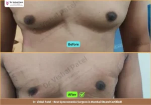 Grade 3 Gynecomastia Surgery in Mumbai - Before & After Photos of Indian Male from Borivali Mumbai - Front View