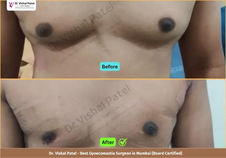 Grade 3 Gynecomastia Surgery in Mumbai - Before & After Photos of Indian Male from Borivali Mumbai - Front View