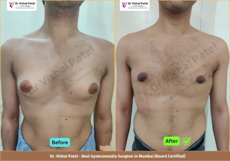 Grade 3 Gynecomastia Surgery in Mumbai - Before & After Photos of Indian Male from Jogeshwari Mumbai - Front View
