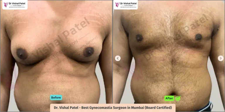 Grade 4 Gynecomastia - Indian Male from Dadar Mumbai - Before After Photo - Front view