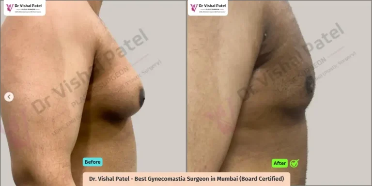 Grade 4 Gynecomastia - Indian Male from Dadar Mumbai - Before After Photo - by Dr Vishal Patel - Side view